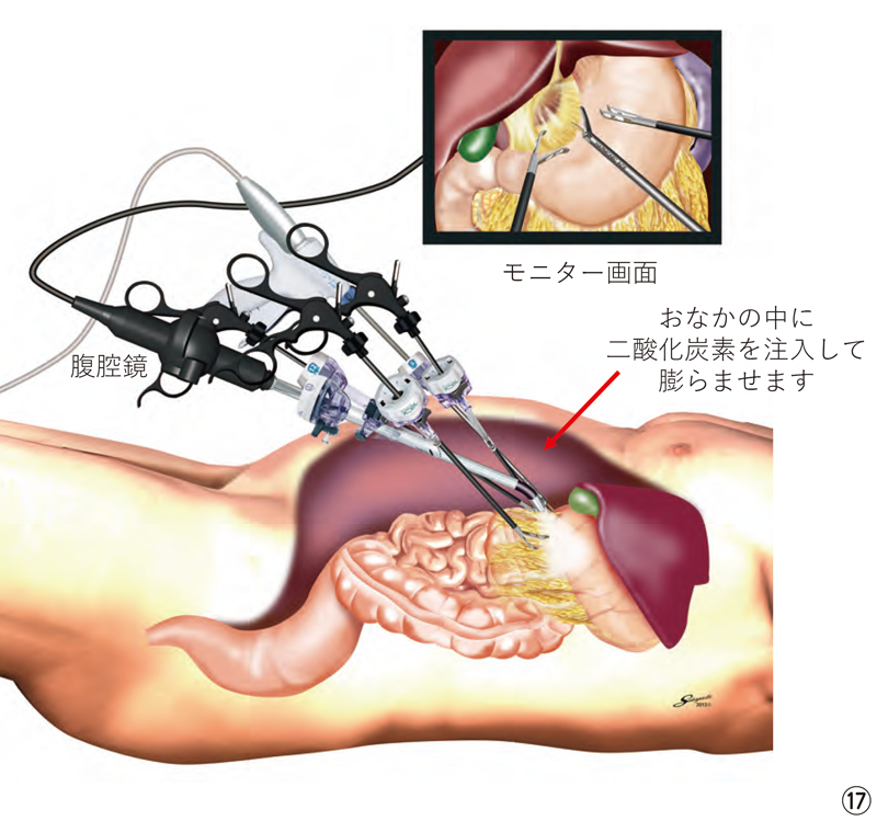 胃の腹腔鏡手術